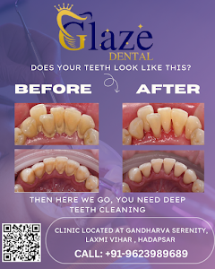 Before and after dental treatment result at Glaze Dental Clinic Hadapsar - Patient transformation 1
