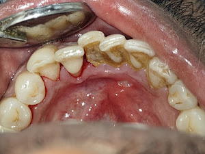 Before and after dental treatment result at Glaze Dental Clinic Hadapsar - Patient transformation 2