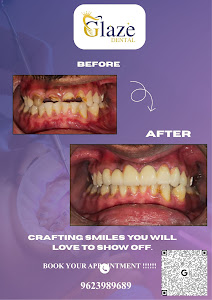Before and after dental treatment result at Glaze Dental Clinic Hadapsar - Patient transformation 4