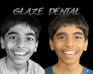 Before and after dental treatment result at Glaze Dental Clinic Hadapsar - Patient transformation 5